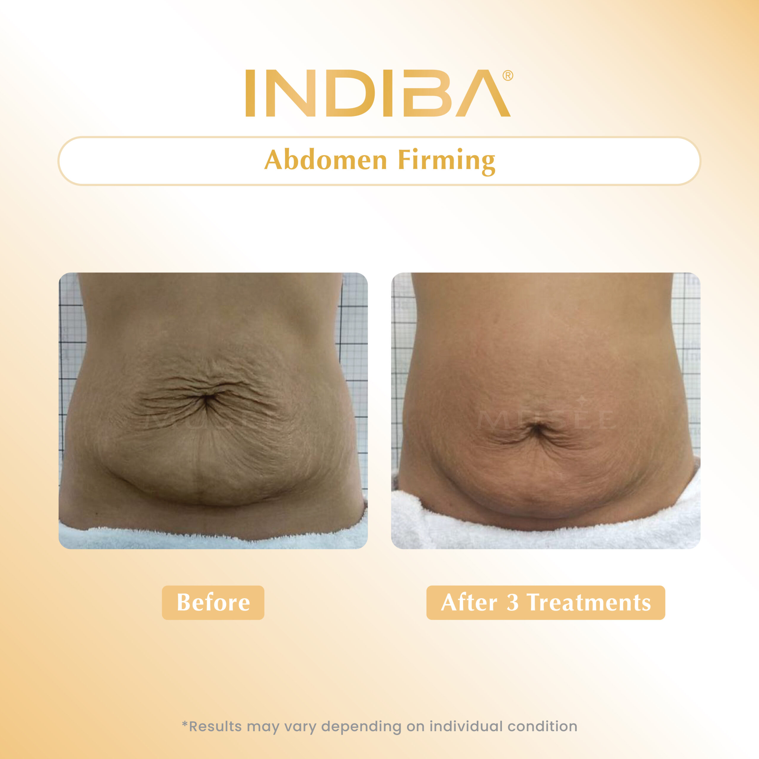 Abdomen Firming_01