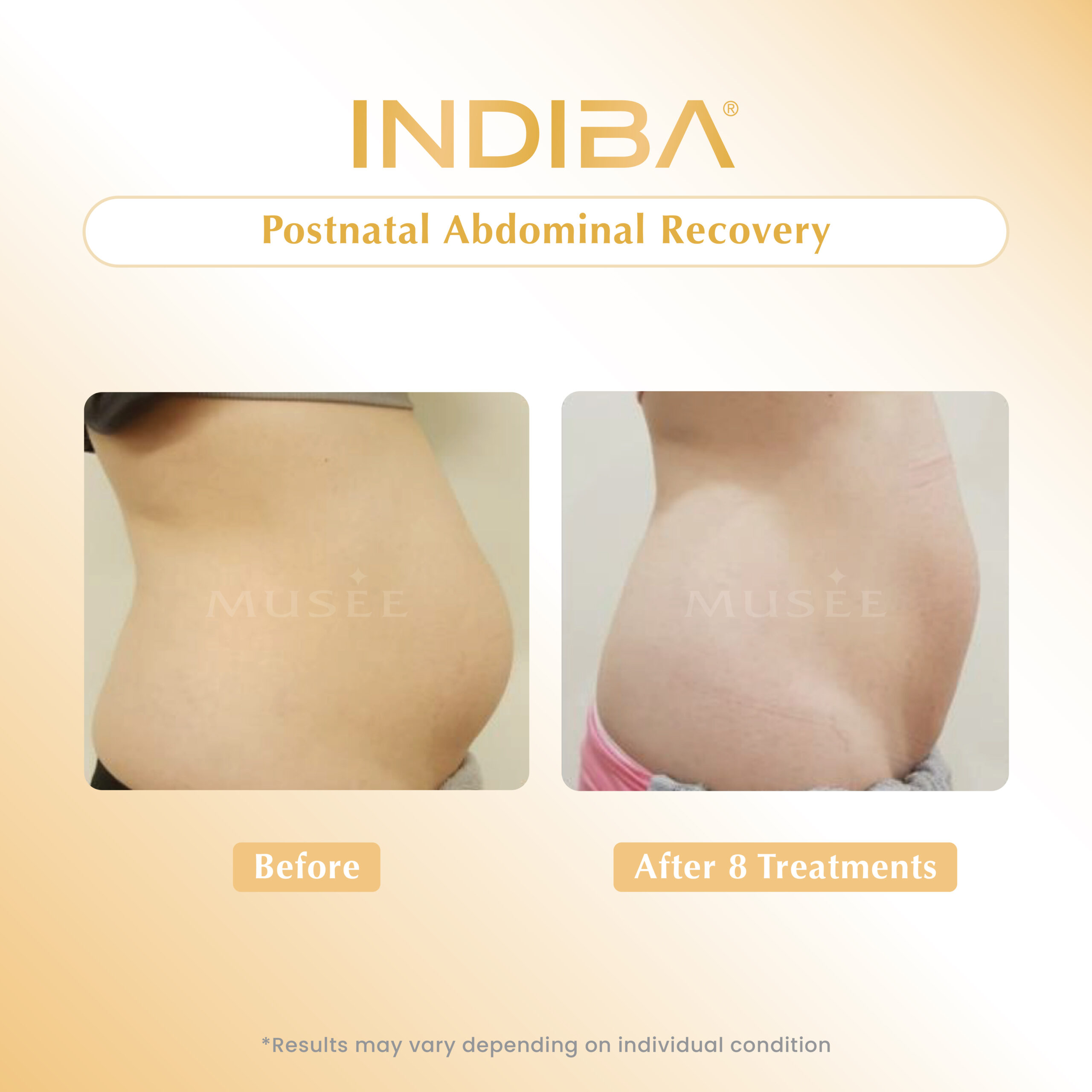 Postnatal Abdominal Recovery_01