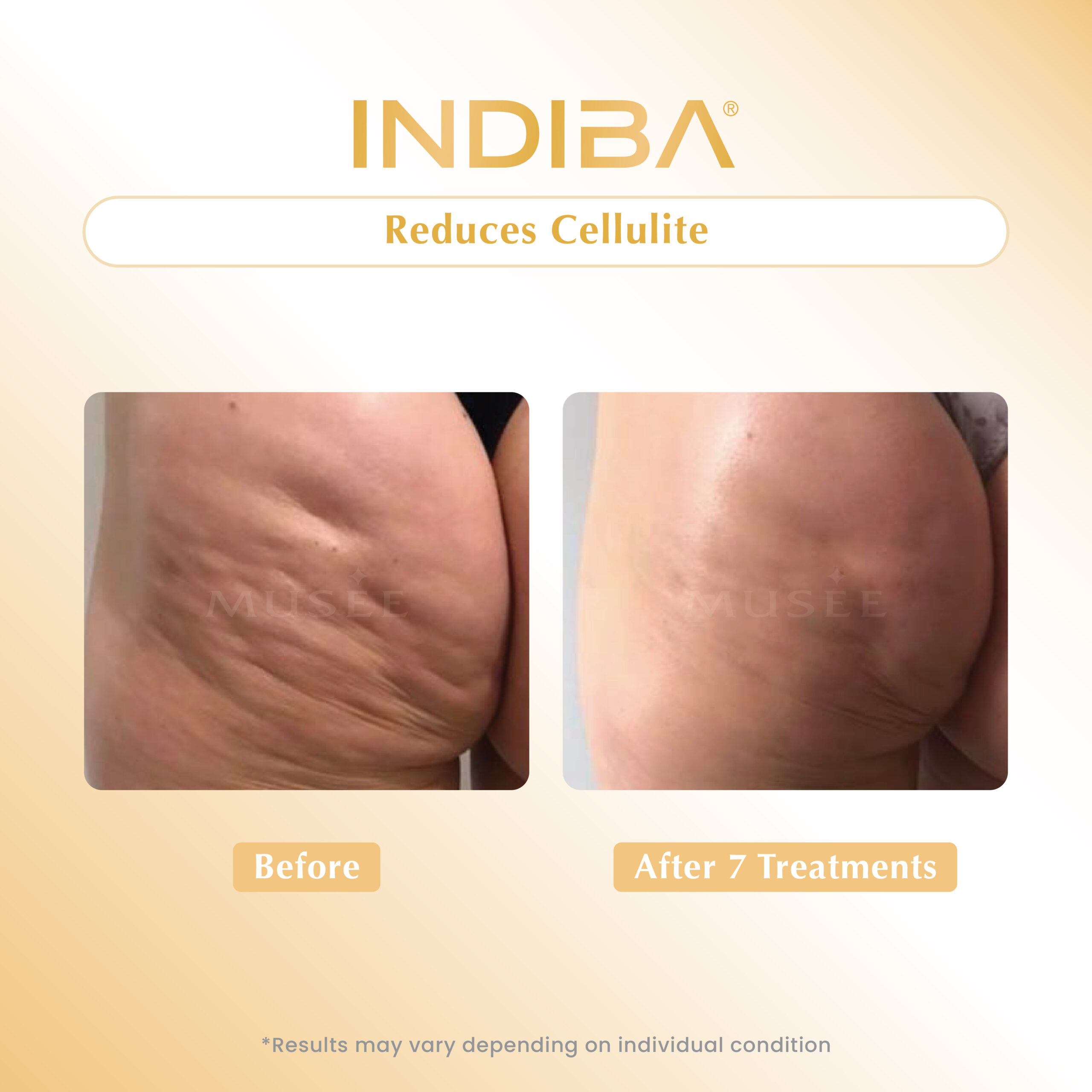 Reduces Cellulite_01