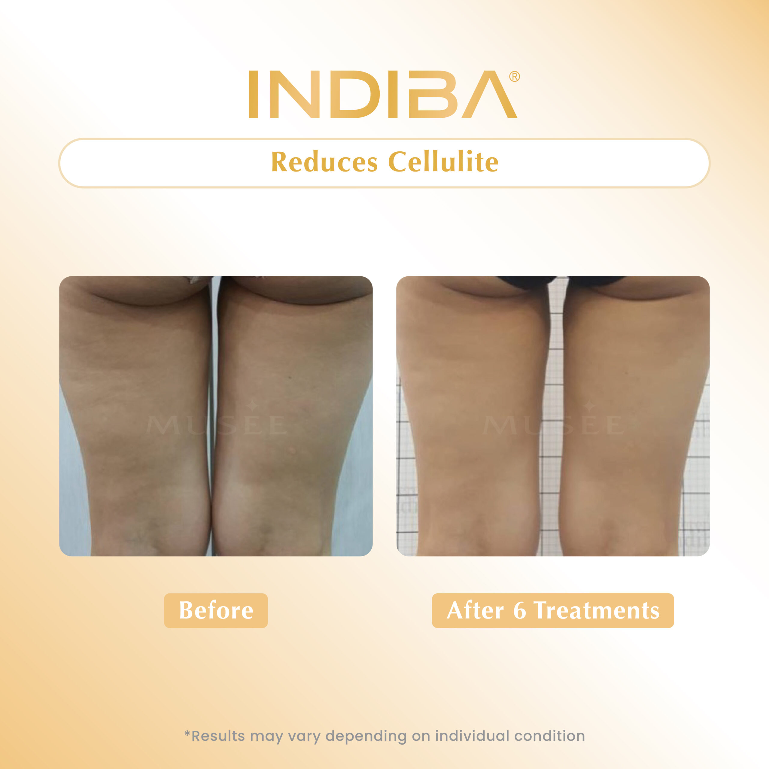 Reduces Cellulite_02
