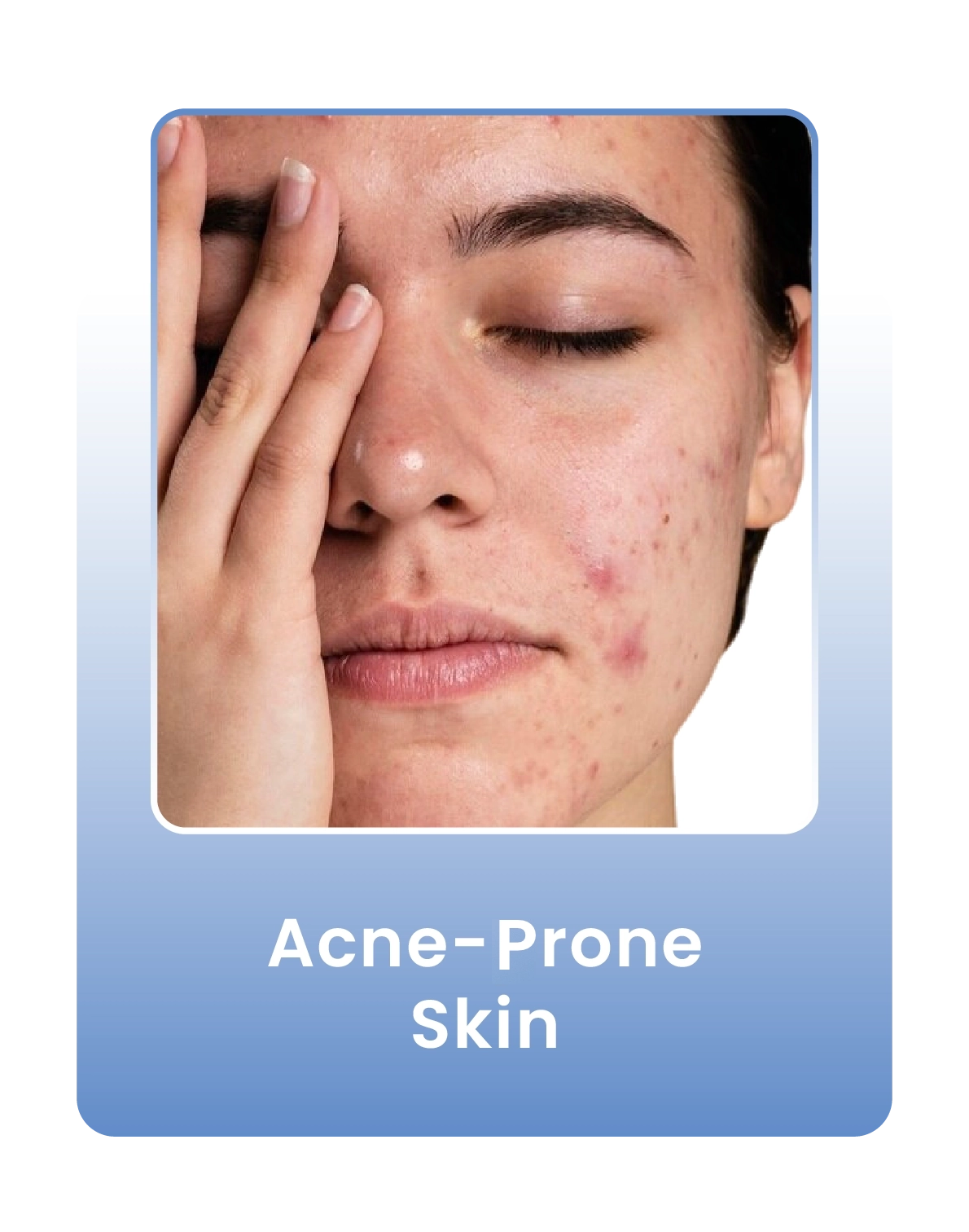 acne_problem-4